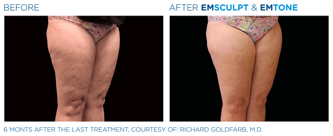 Before and After EMSculpt and EMTone treatment | SOSA Medical Aesthetics in Tampa, FL