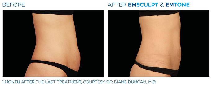Before and After EMSculpt and EMTone treatment | SOSA Medical Aesthetics in Tampa, FL