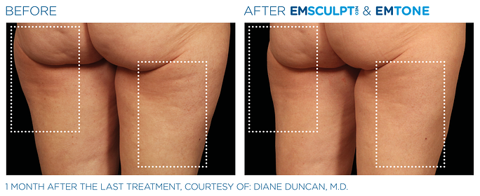 Before and After EMSculpt Neo and EMTone treatment | SOSA Medical Aesthetics in Tampa, FL
