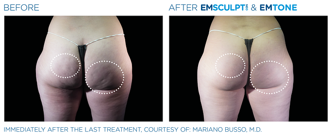 Before and After EMSculpt Neo and EMTone treatment | SOSA Medical Aesthetics in Tampa, FL
