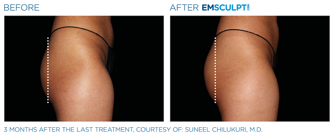 Before and After Emsculpt Neo treatment | SOSA Medical Aesthetics in Tampa, FL