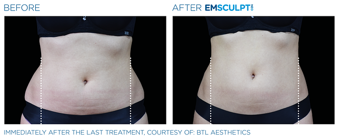 Before and After Emsculpt Neo treatment | SOSA Medical Aesthetics in Tampa, FL