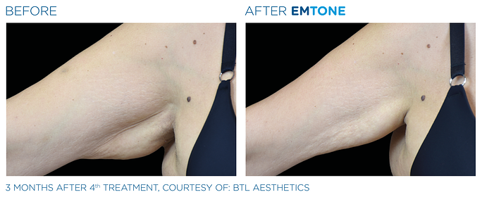 Before and After EMTone treatment | SOSA Medical Aesthetics in Tampa, FL