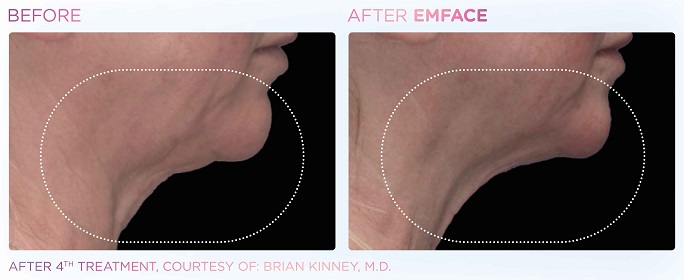 Before and After Emface treatment | SOSA Medical Aesthetics in Tampa, FL