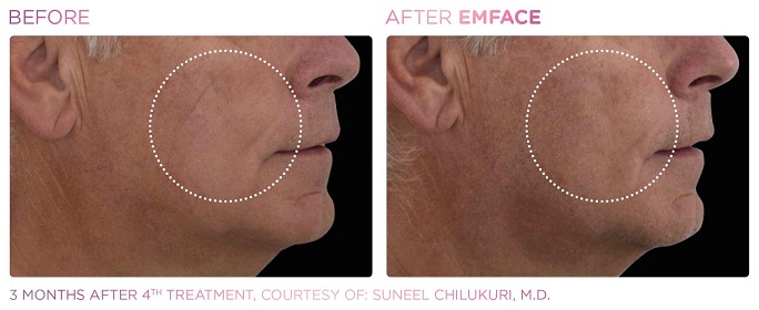 Before and After Emface treatment | SOSA Medical Aesthetics in Tampa, FL