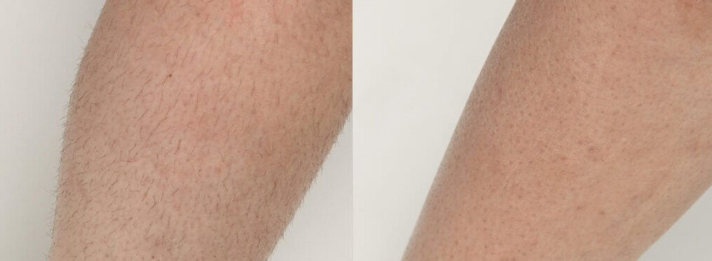 diolazexl-before-after-dr-j-diamond-preview-1-1024x432