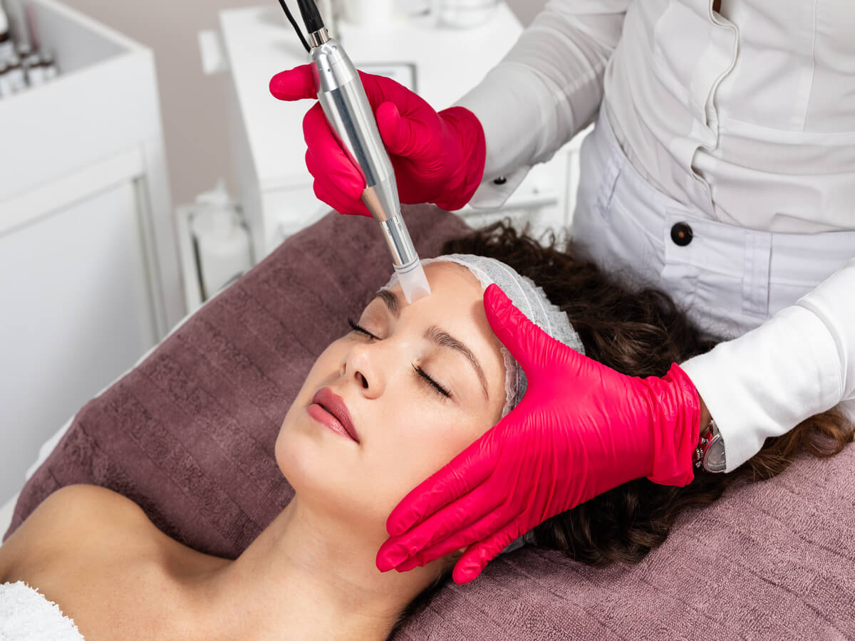 Microneedling-By-SOSA-Medical-Aesthetics-in-Tampa-FL