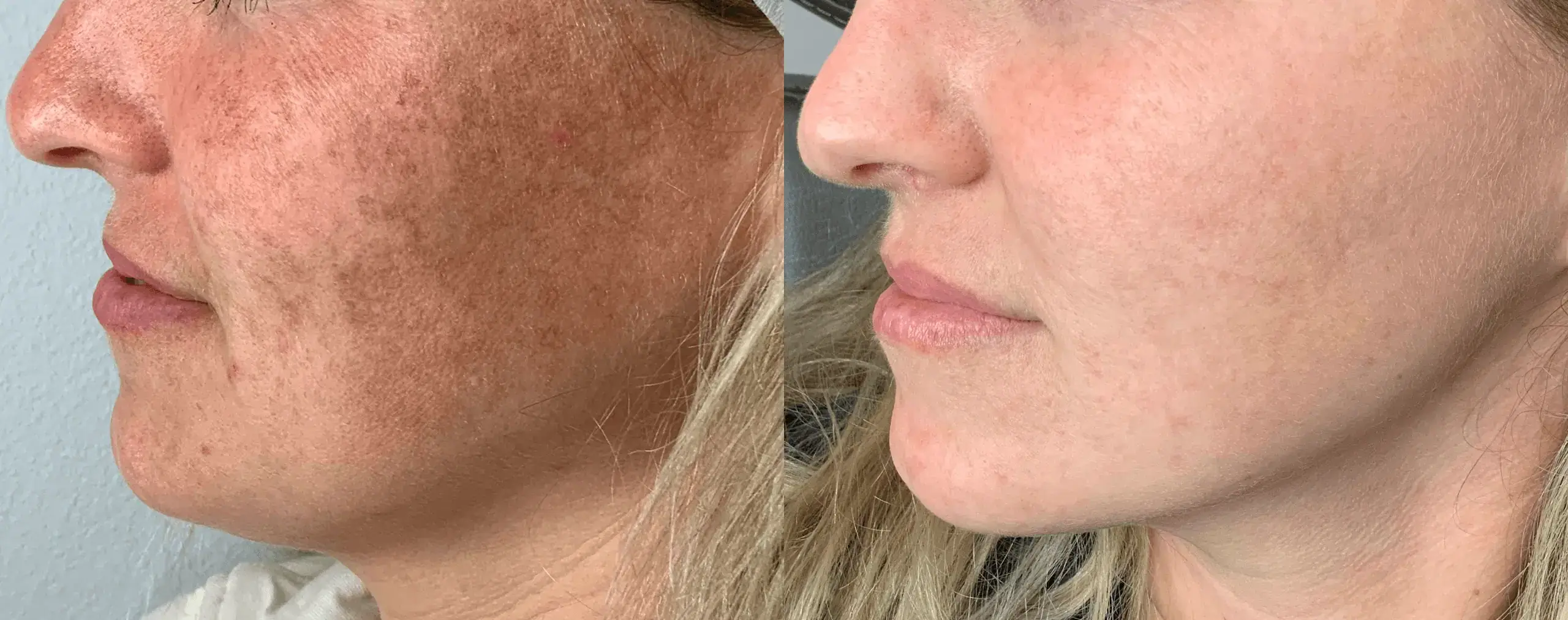 lumecca-before-after-8445-med-spa-preview-1-1